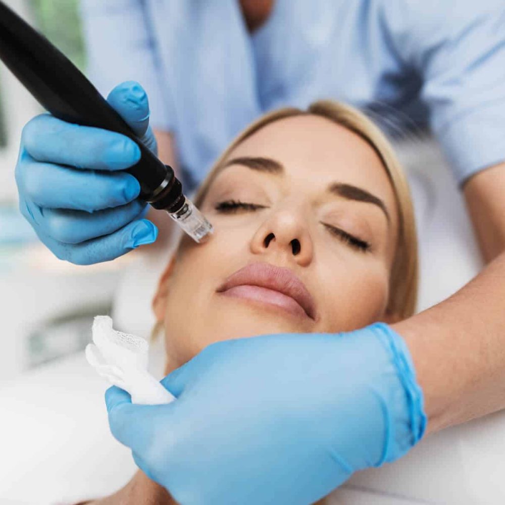 micro-needling2 micro-needling2